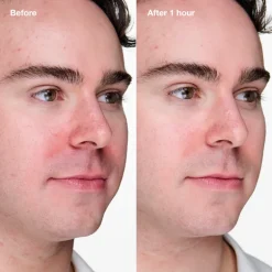 Anti-Blemish Solutions Clinical Advanced Clearing Gel